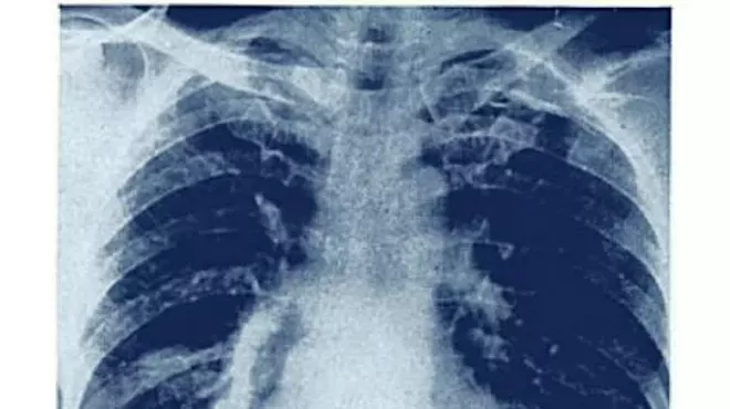 Image: Film Screening & Talk-back - Dr. Chasis And The Battle Against Tuberculosis